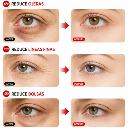 LumiEyes™ — Lentes Anti Bolsas y Ojeras